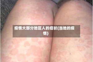 疫情大部分地区人的症状(当地的疫情)